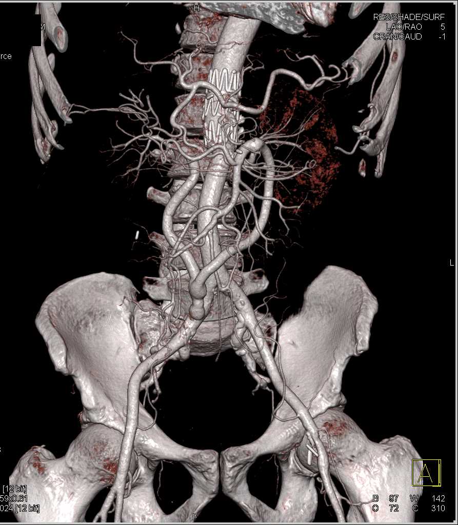 Multiple Grafts Arising from the Right Common Iliac Artery - CTisus CT Scan