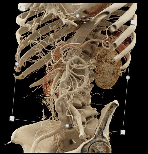 Multiple Grafts Arising from the Right Common Iliac Artery - CTisus CT Scan