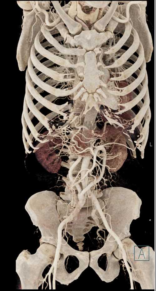 Multiple Grafts Arising from the Right Common Iliac Artery - CTisus CT Scan