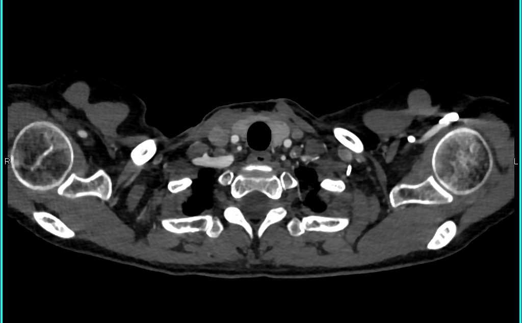 Ductus off Aortic Arch - CTisus CT Scan