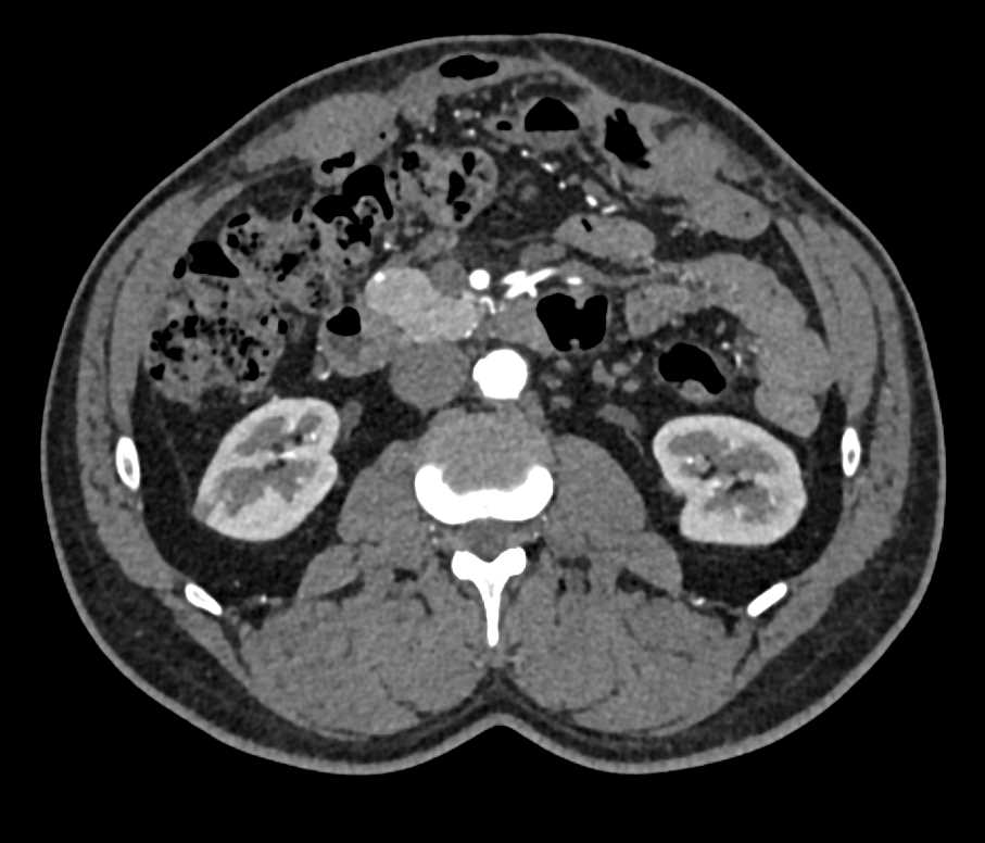 Under 1cm GDA Aneurysm - CTisus CT Scan