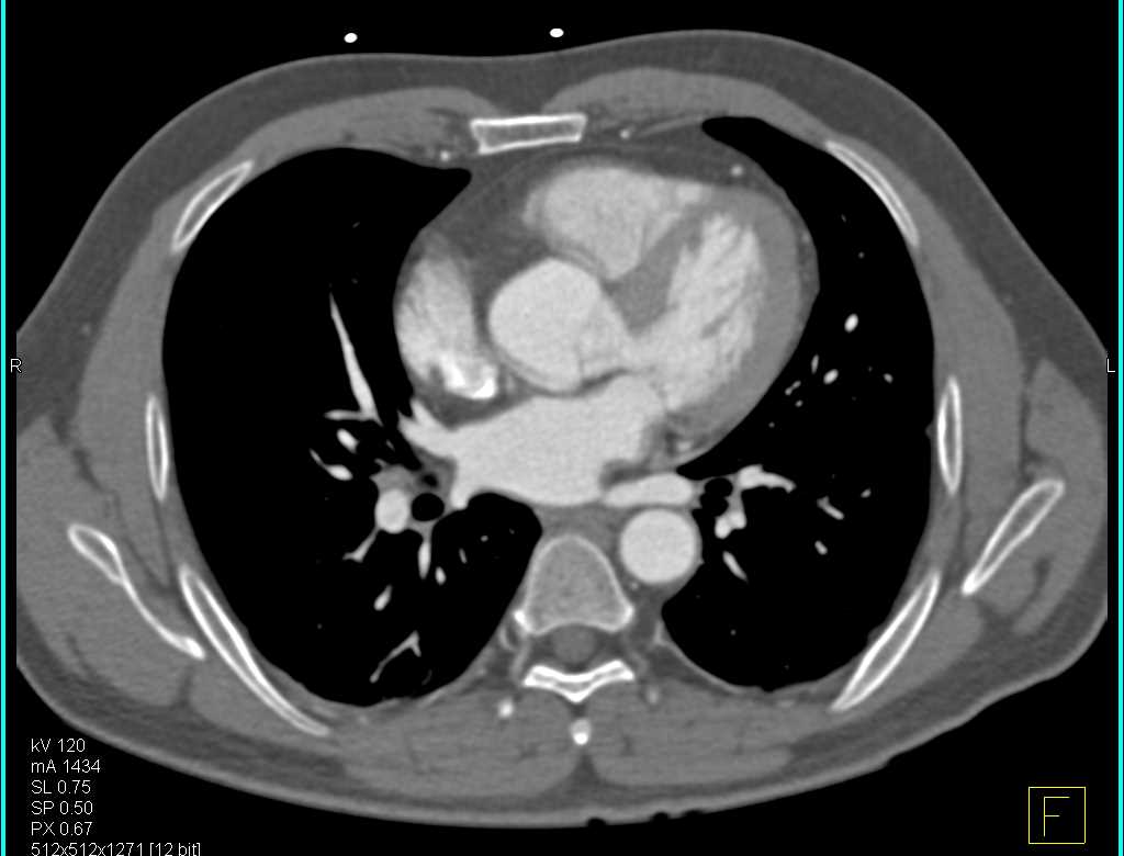 Vasculitis Involves the Celiac and SMA - CTisus CT Scan