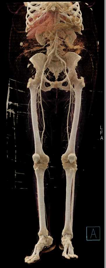 Plaque in the Runoff Vessels - CTisus CT Scan