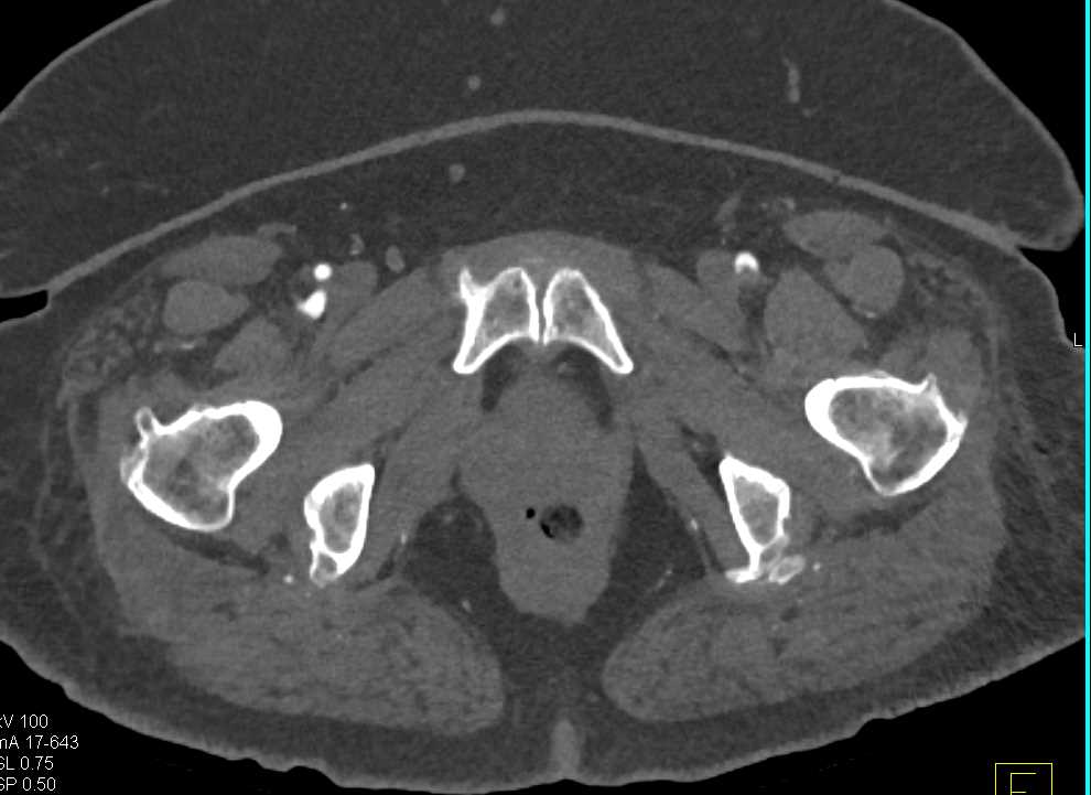 Plaque in the Runoff Vessels Best Seen by the Left Femoral Artery and SFA - CTisus CT Scan