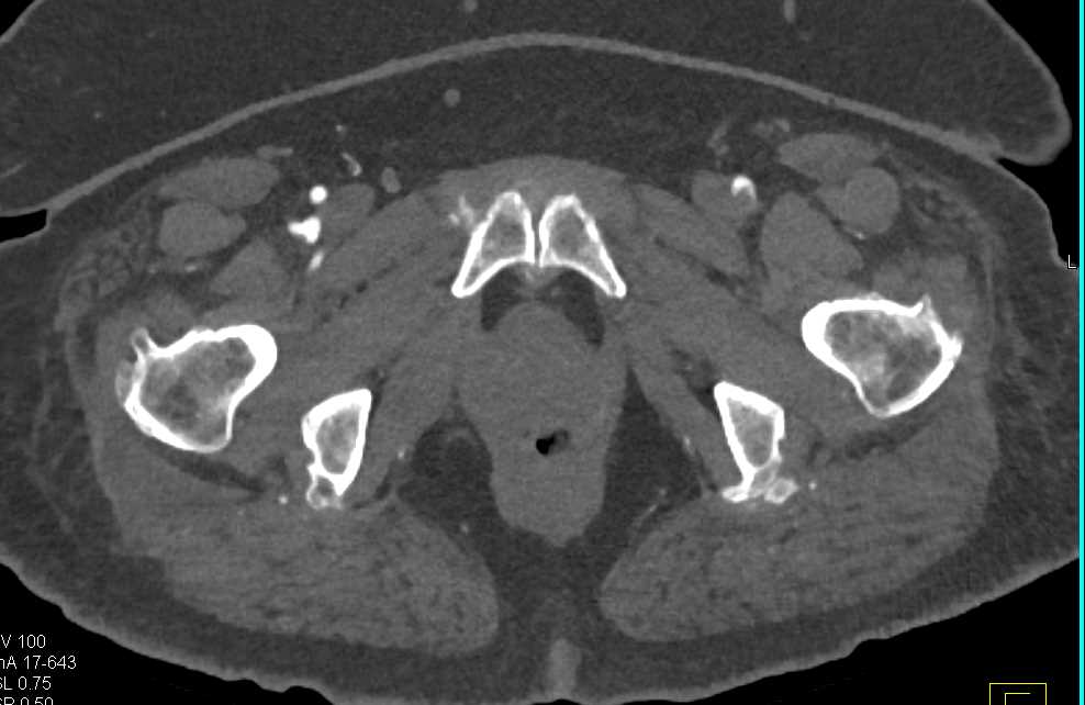 Plaque in the Runoff Vessels Best Seen by the Left Femoral Artery and SFA - CTisus CT Scan