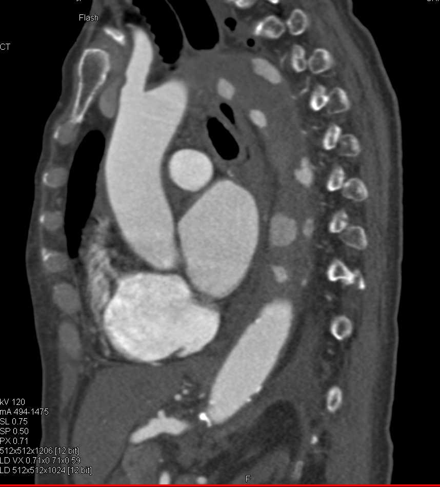 Aortic Dissection with Active Bleeding - CTisus CT Scan