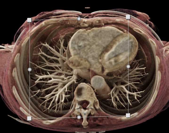 Vascular Mapping with Prominent GDA - CTisus CT Scan