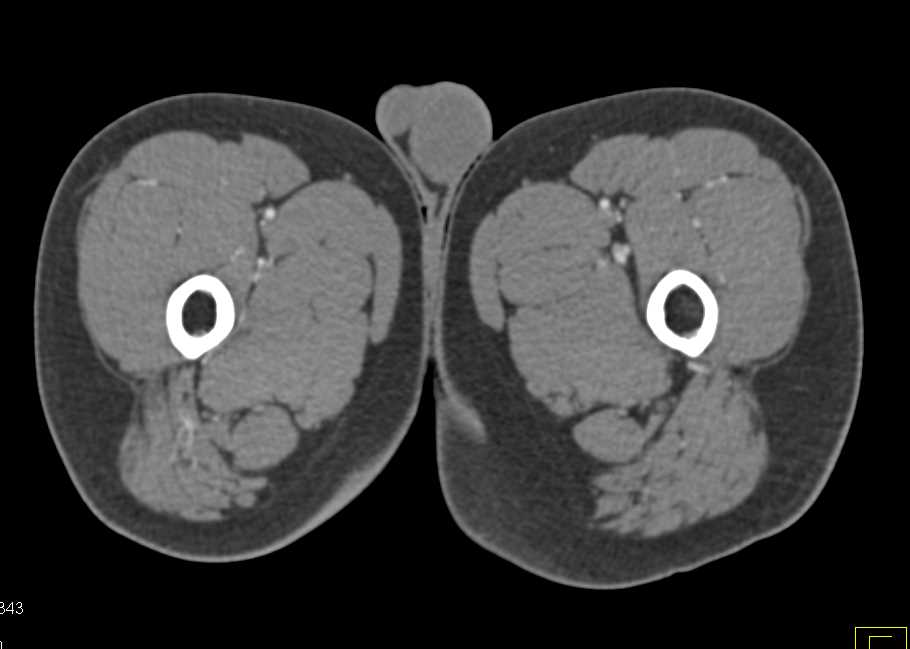 Occluded Right External Iliac Artery - CTisus CT Scan