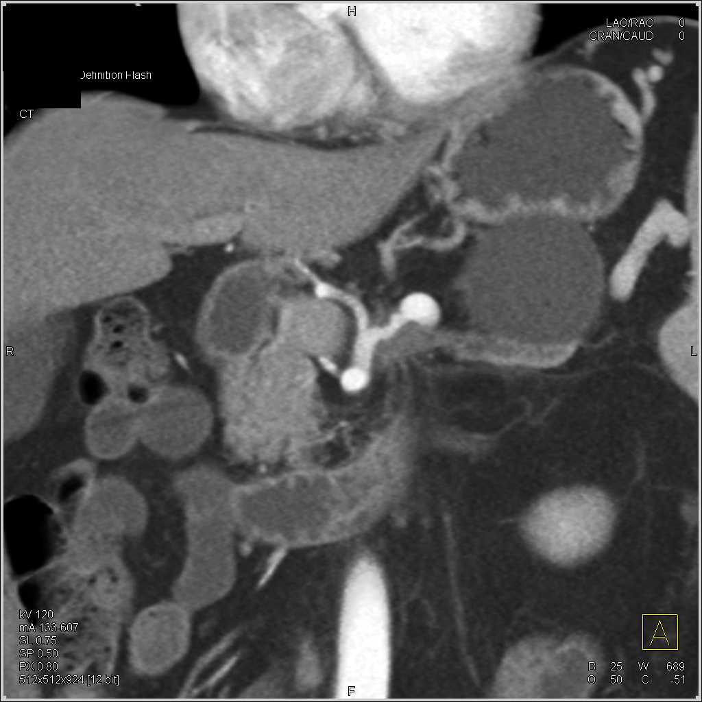 Splenic Artery Aneurysm - CTisus CT Scan