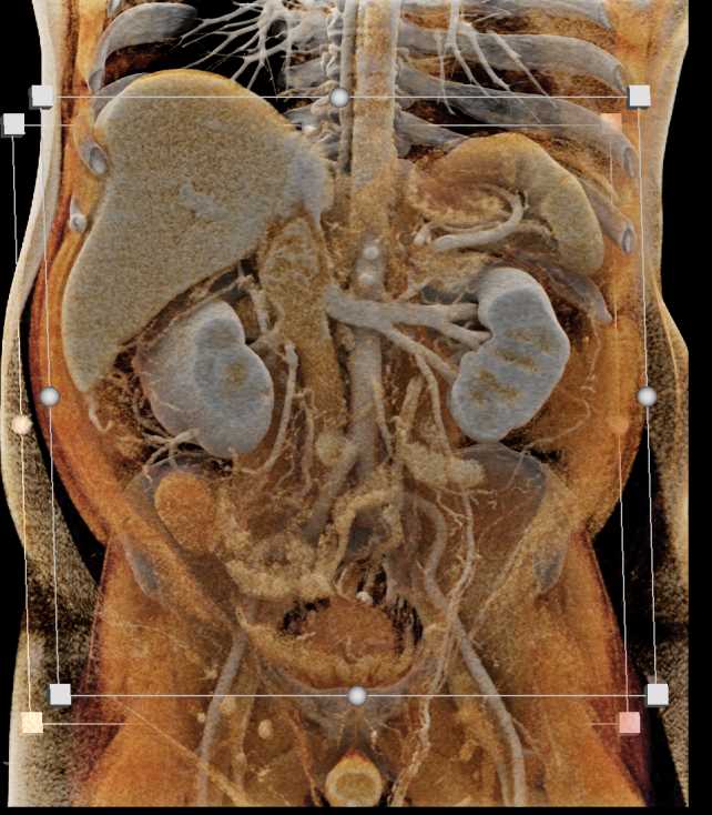 Renal Cell Carcinoma Invades the Right Renal Vein and the IVC - CTisus CT Scan