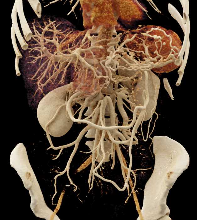 Pancreas Adenocarcinoma with Vessel Invasion - CTisus CT Scan