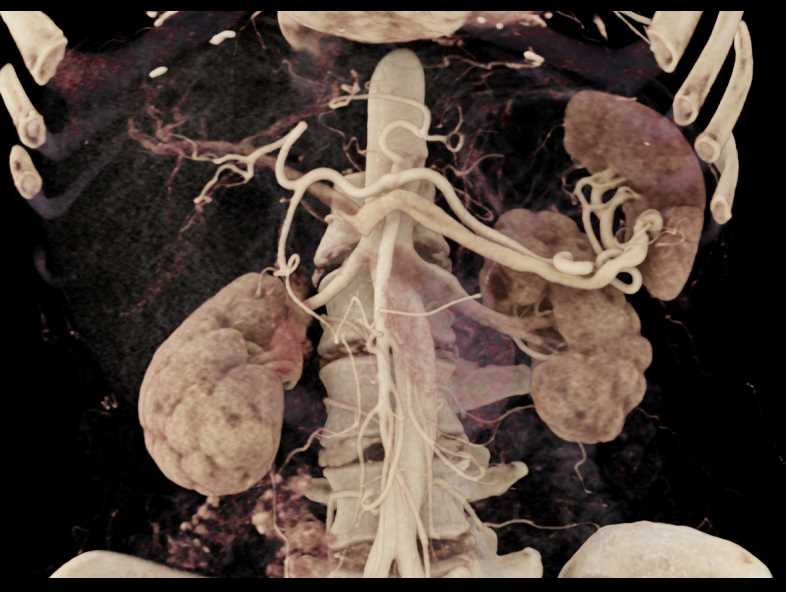 Good Visualization of Splenic Artery and Vein - CTisus CT Scan