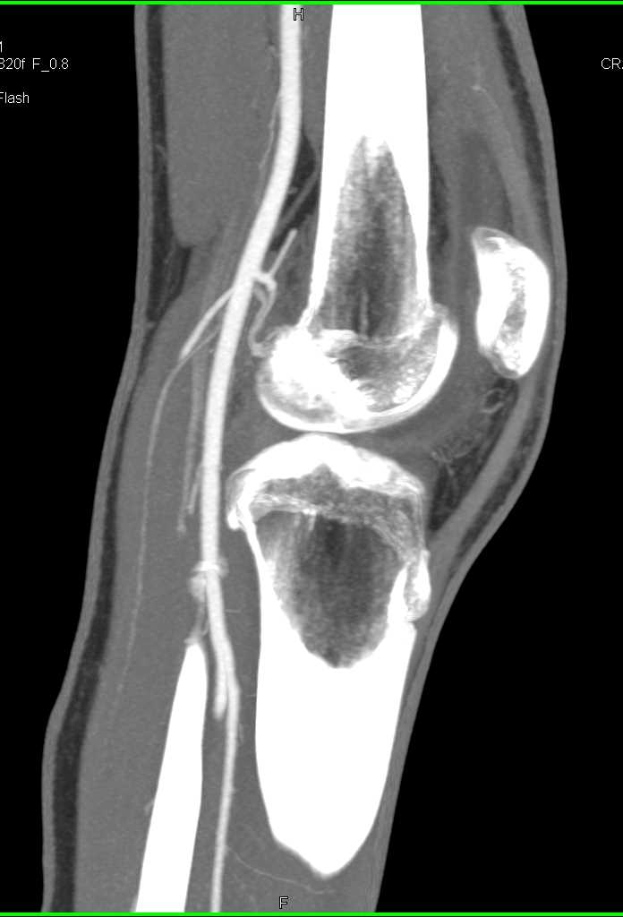 Patent Popliteal Artery - CTisus CT Scan