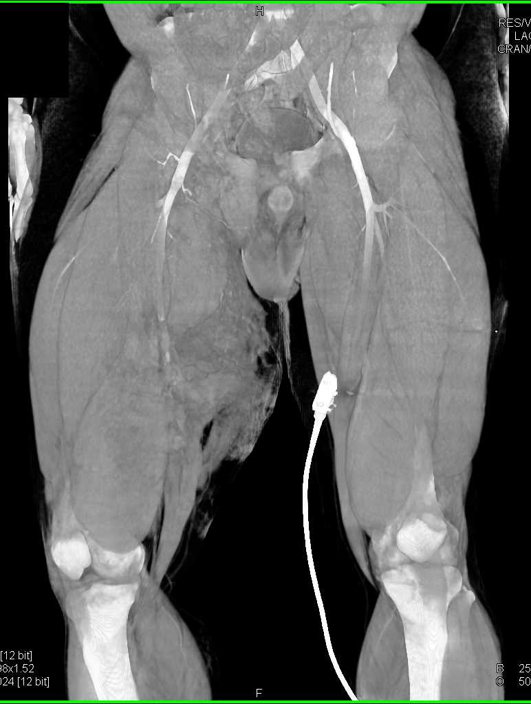 Trauma to Right Thigh with SFA Occlusion - CTisus CT Scan