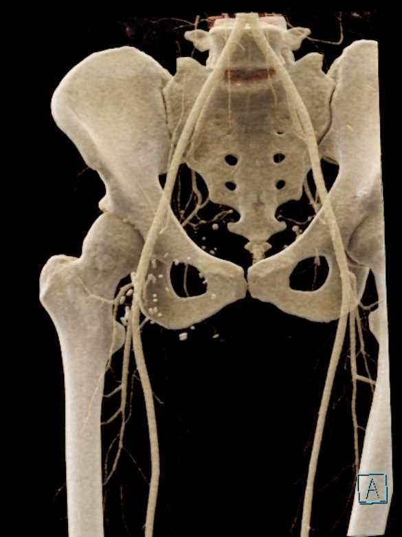 Induration Right Groin from IVDA - CTisus CT Scan