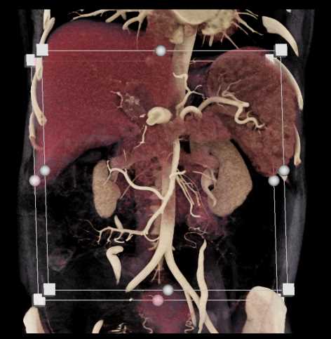 Hepatic Artery Aneurysm - CTisus CT Scan