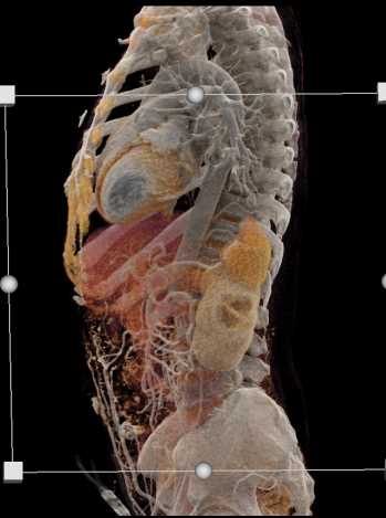 Occlusion of the Abdominal Aorta Beneath the Renal Arteries - CTisus CT Scan