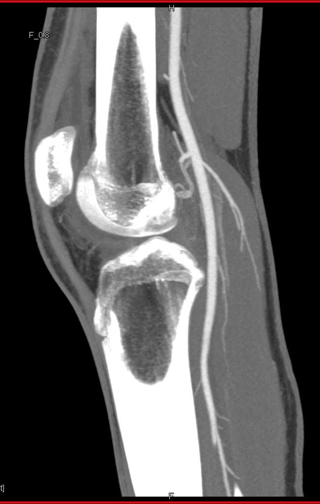 Patent Popliteal Artery - CTisus CT Scan
