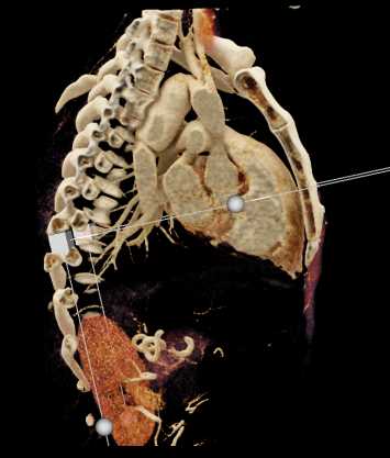 Coarctation of the Aorta - CTisus CT Scan
