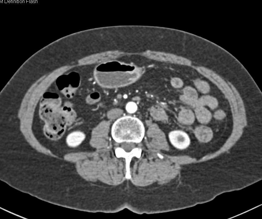 Superior Mesenteric Artery (SMA) Vasculitis - CTisus CT Scan