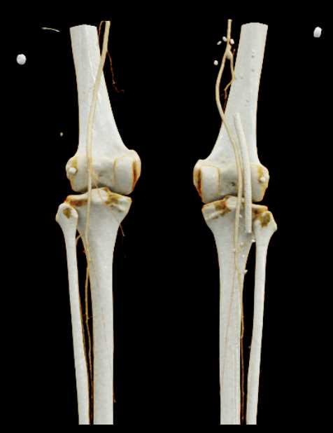 Run off with Failed Stent and Bypass Graft - CTisus CT Scan
