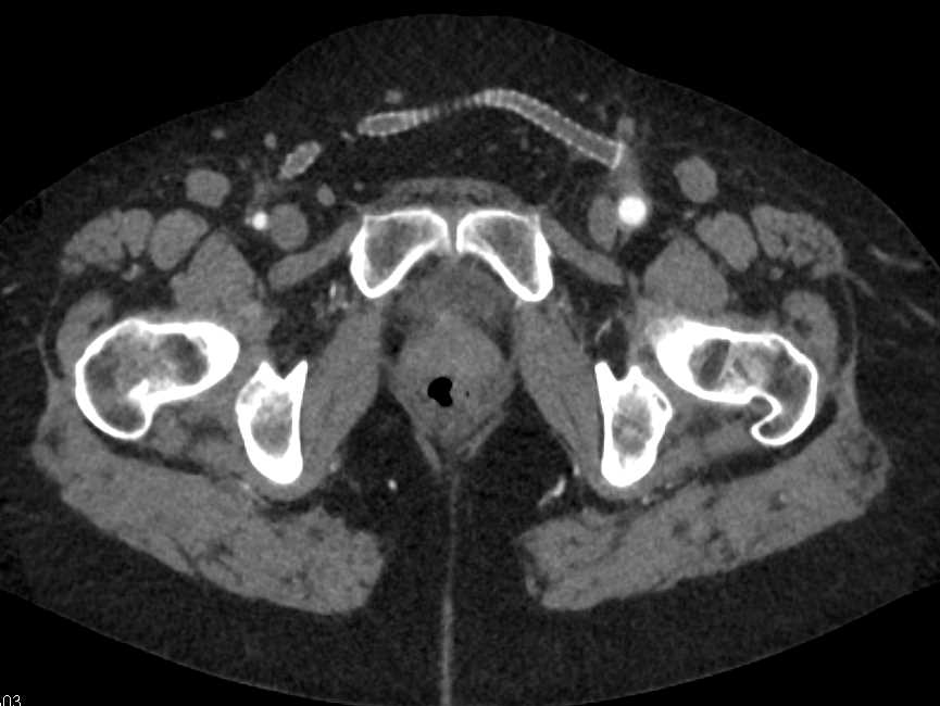 Occluded Right Common Iliac Artery and Fem-Fem Bypass Graft - CTisus CT Scan