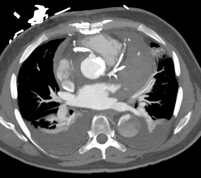 Aortic Dissection - CTisus CT Scan