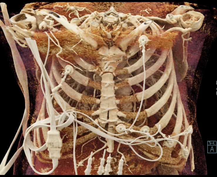 Aortic Dissection - CTisus CT Scan