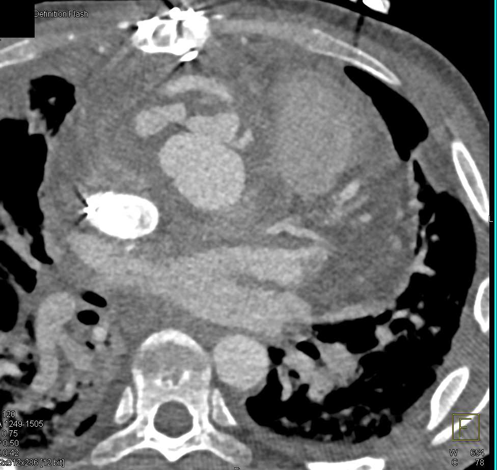 Aortic Dissection with Repair - CTisus CT Scan