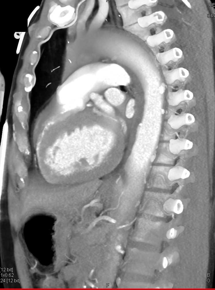 Intramural Hematoma Aorta - CTisus CT Scan