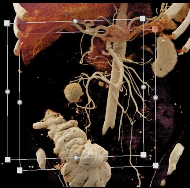 Mesenteric Artery Aneurysm - CTisus CT Scan