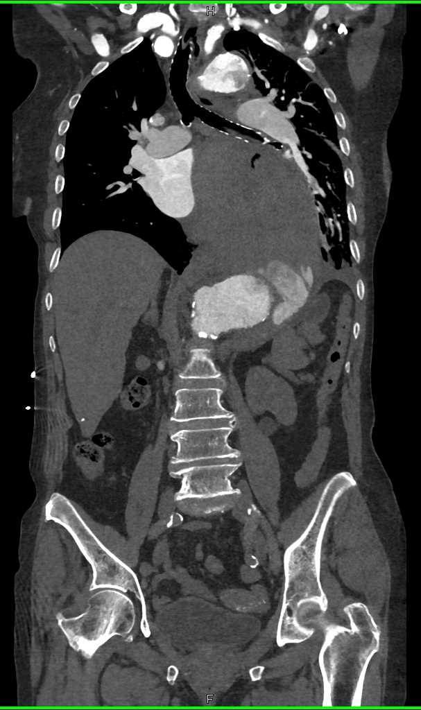 Large Aortic Aneurysm with Turbulent Flow - CTisus CT Scan