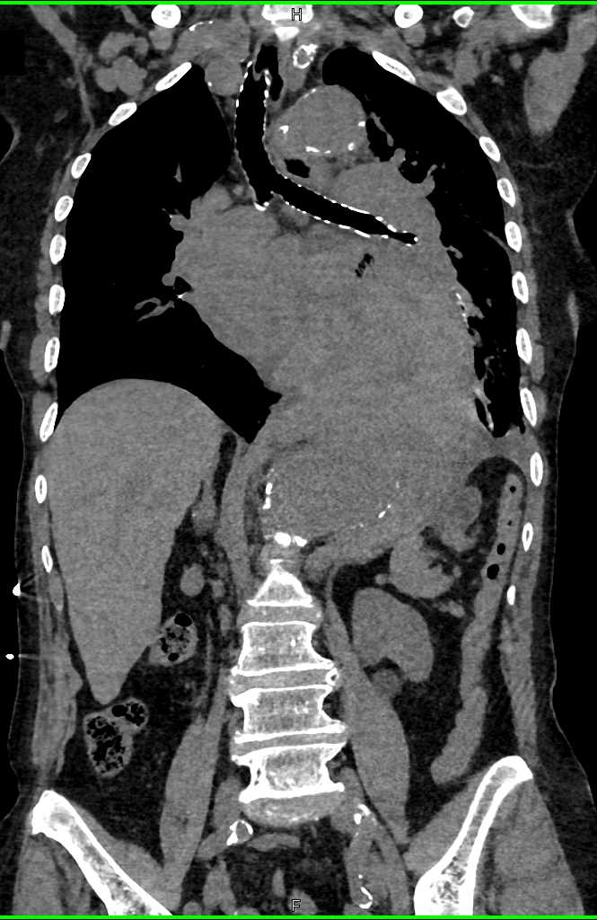 Large Aortic Aneurysm with Turbulent Flow - CTisus CT Scan