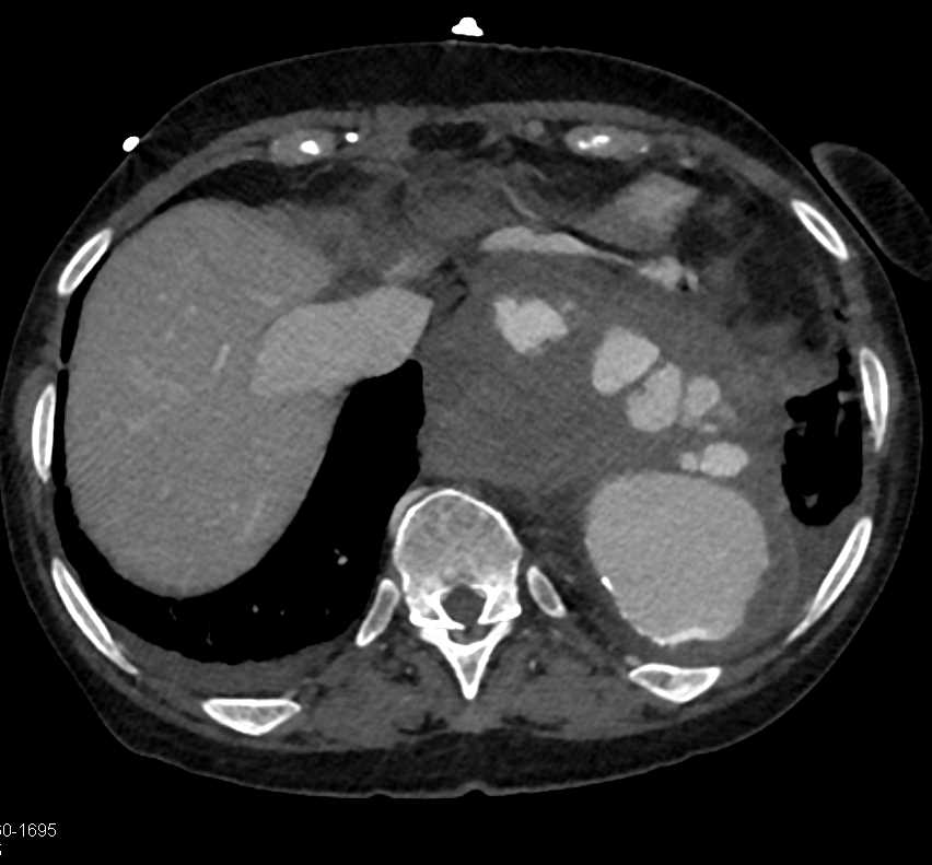 Large Aortic Aneurysm with Turbulent Flow and Ulceration and Bleed - CTisus CT Scan