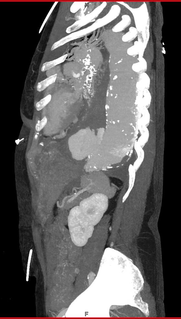 Large Aortic Aneurysm with Turbulent Flow and Ulceration and Bleed - CTisus CT Scan