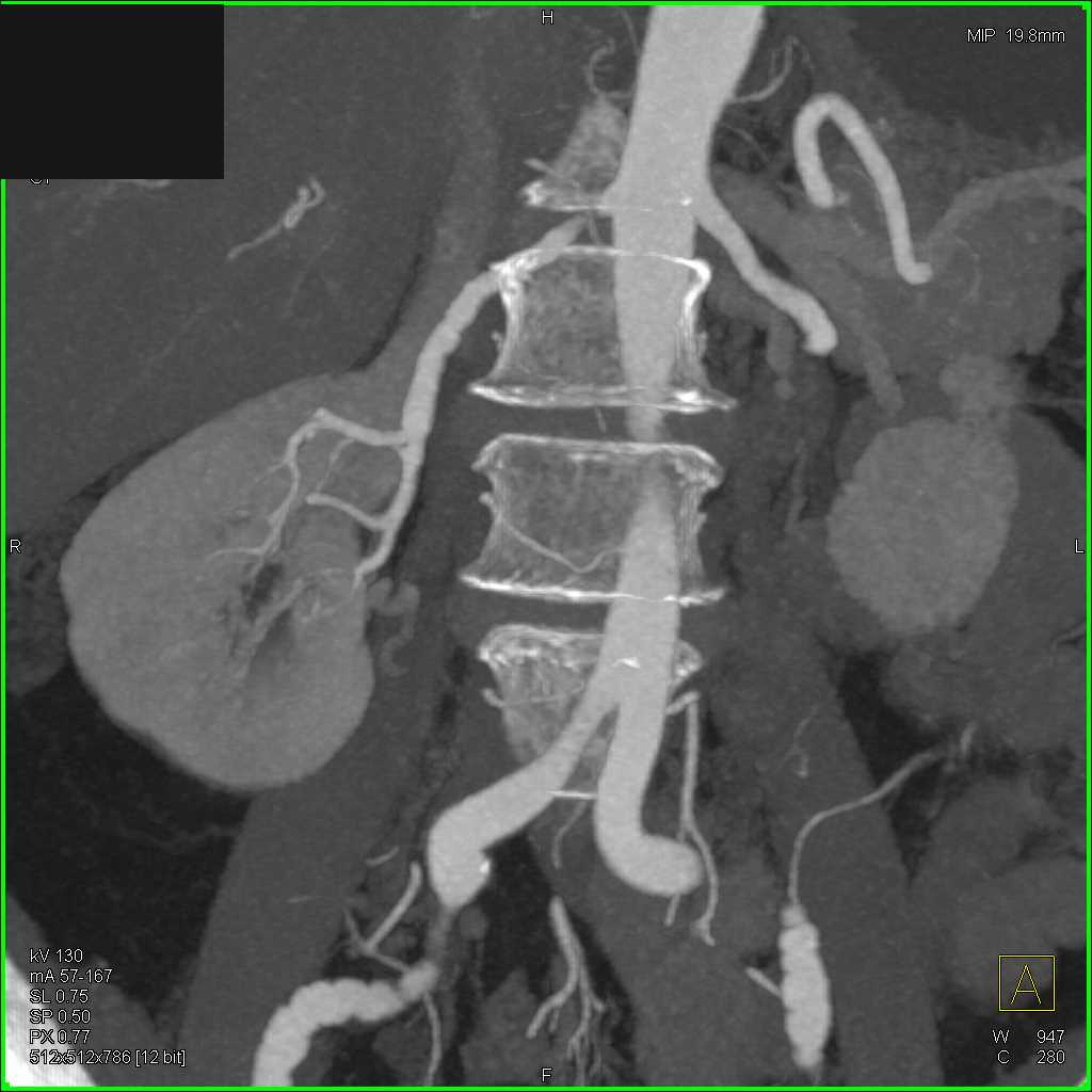 FMD Right Renal Artery and Iliac Arteries - CTisus CT Scan