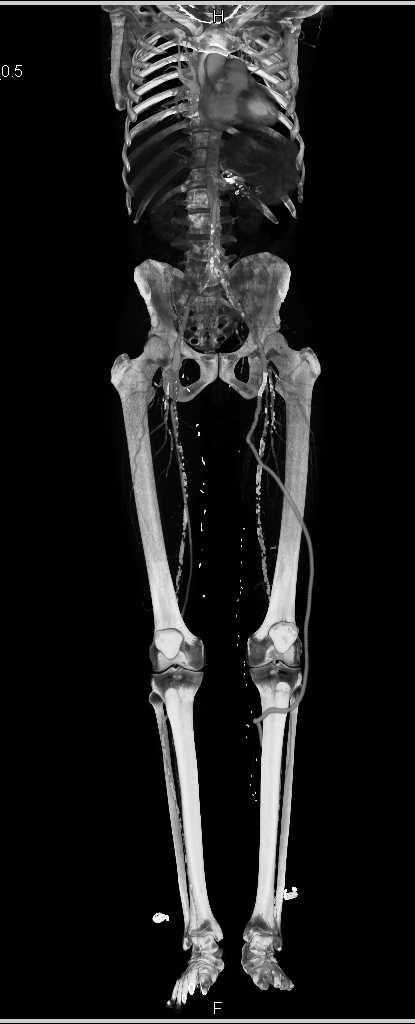 Peripheral Arterial Disease (PAD) with Vascular Bypass Graft - CTisus CT Scan