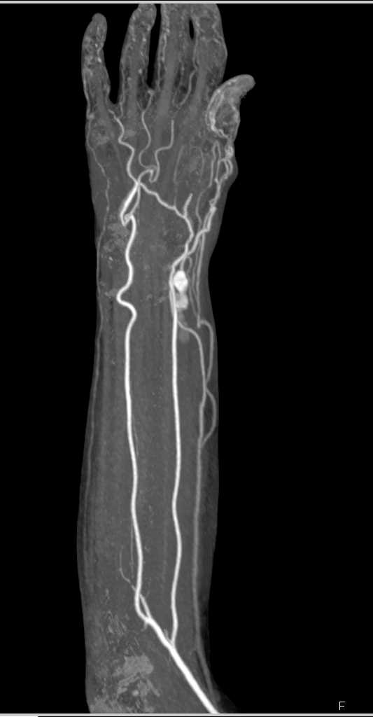 Pseudoaneurysm Distal Radial Artery - CTisus CT Scan