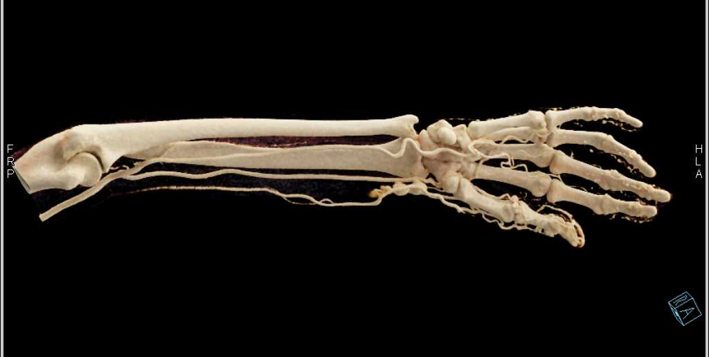 Pseudoaneurysm Distal Radial Artery - CTisus CT Scan