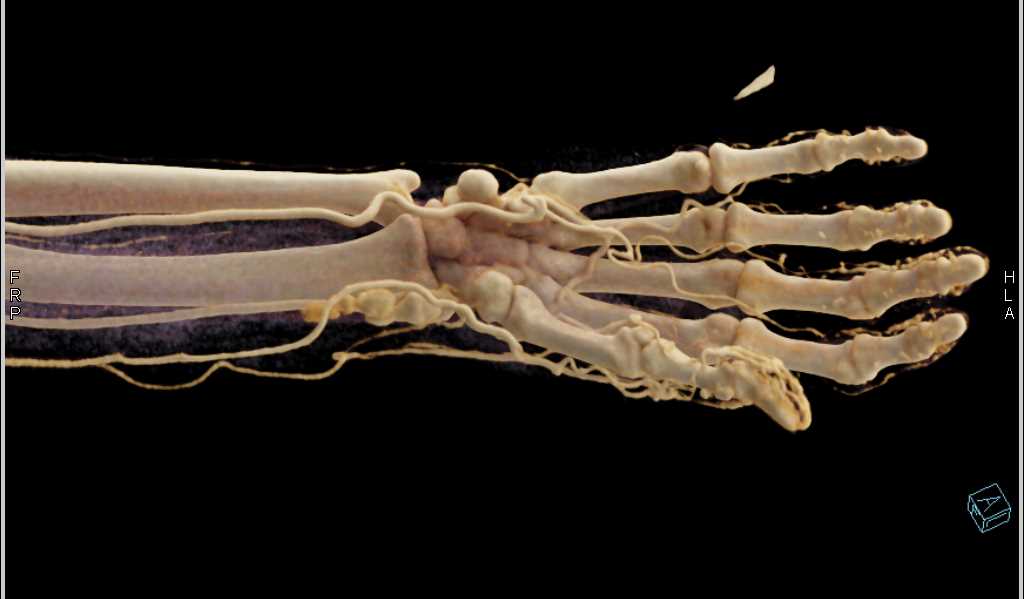 Pseudoaneurysm Distal Radial Artery - CTisus CT Scan