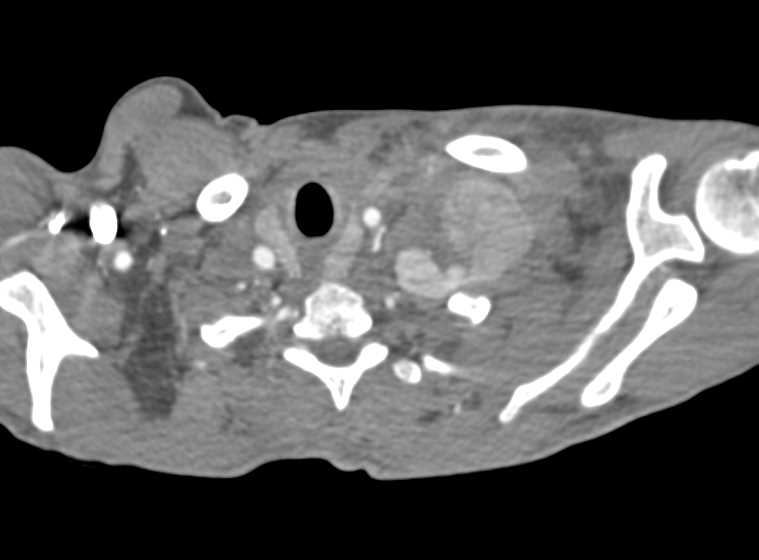 Aneurysm Off Subclavian Artery - CTisus CT Scan