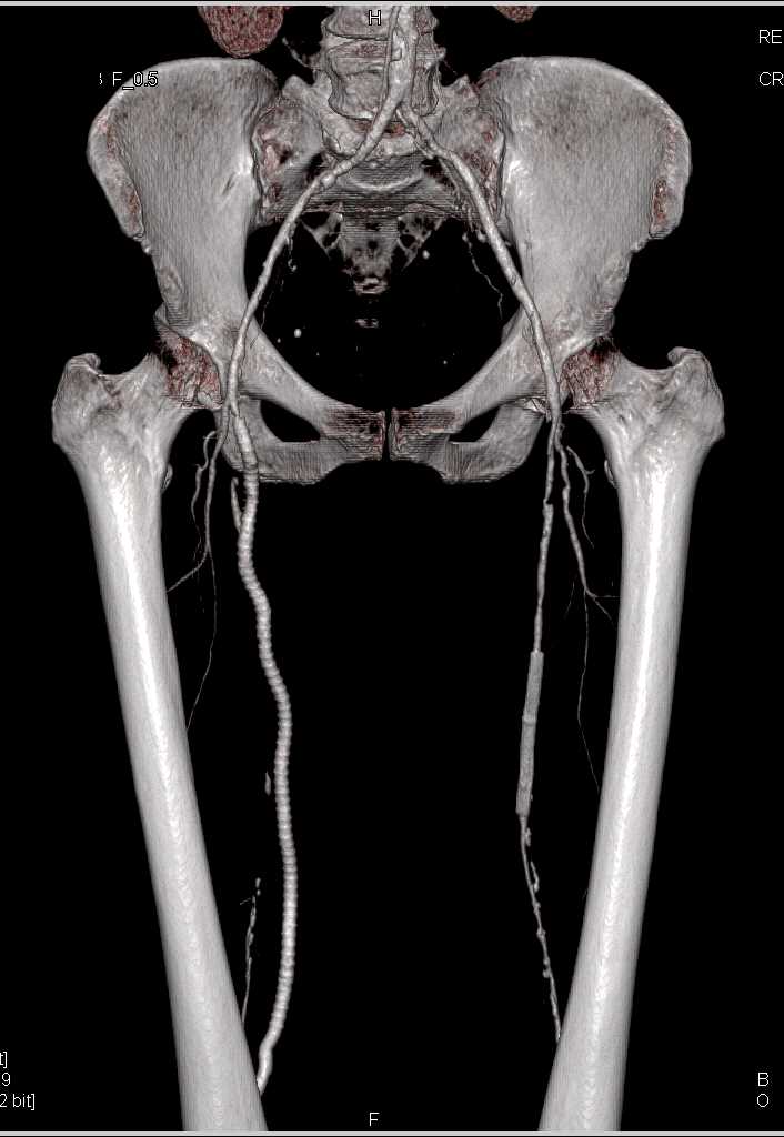 Vascular Bypass and Stenting on CTA Runoff - CTisus CT Scan