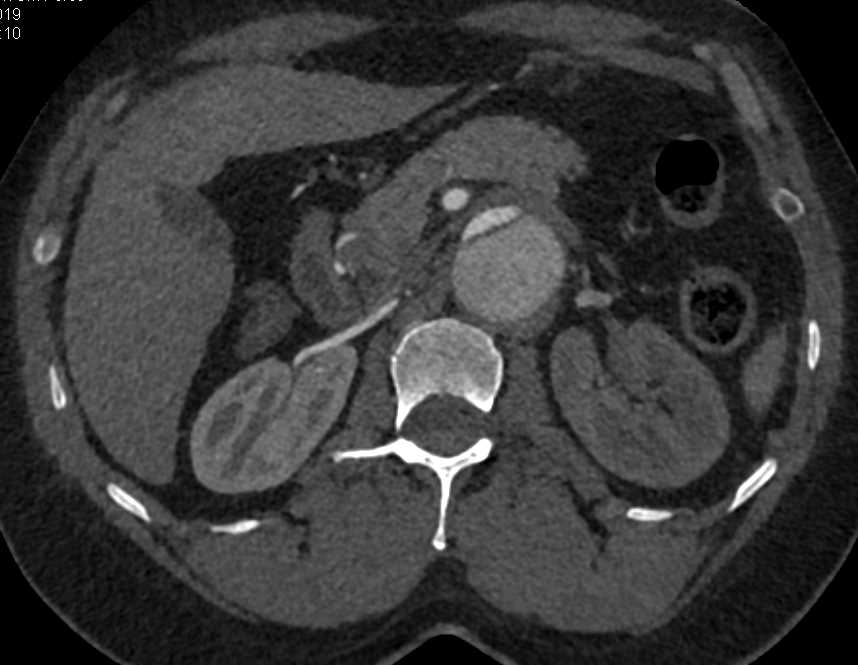 Aortic Dissection - CTisus CT Scan