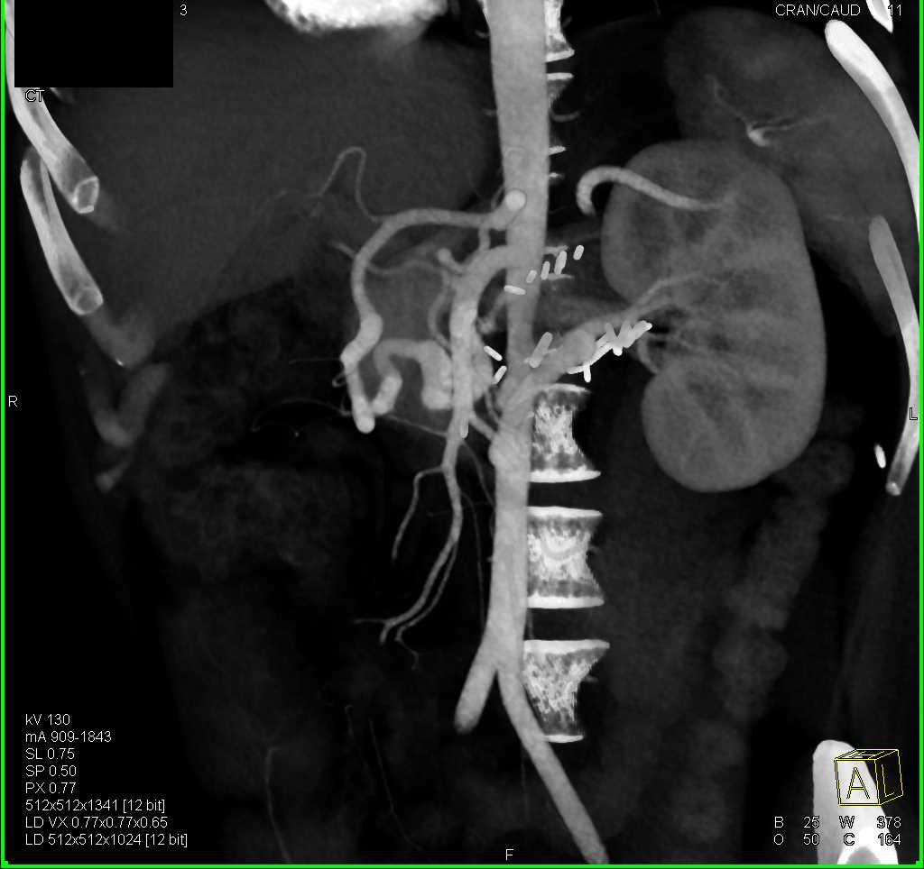 Vascular Bypass Grafting - CTisus CT Scan