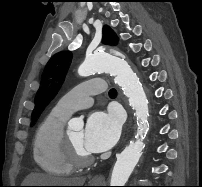 Endovascular Stent Repair - CTisus CT Scan