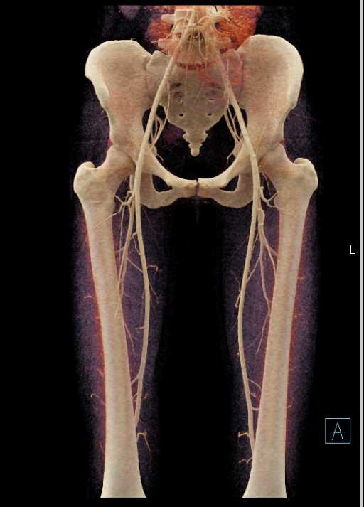 Vascular Mapping for Vascular Reconstruction - CTisus CT Scan