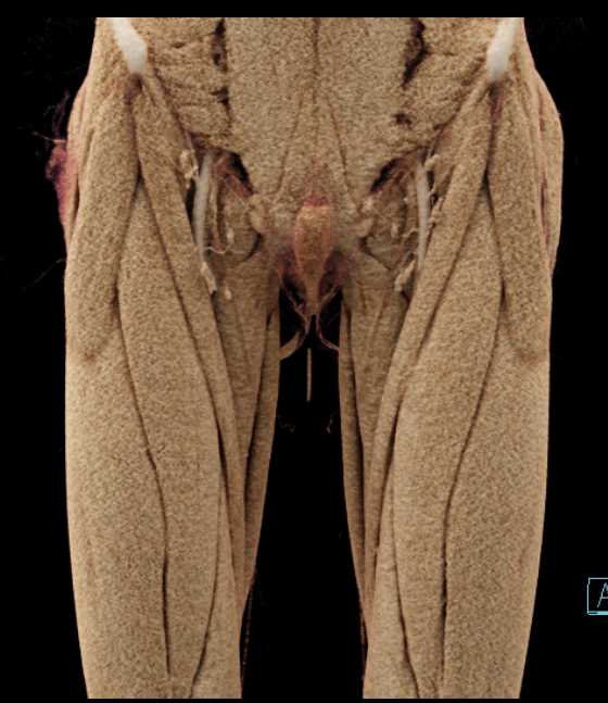 Vascular Mapping for Flap Planning - CTisus CT Scan