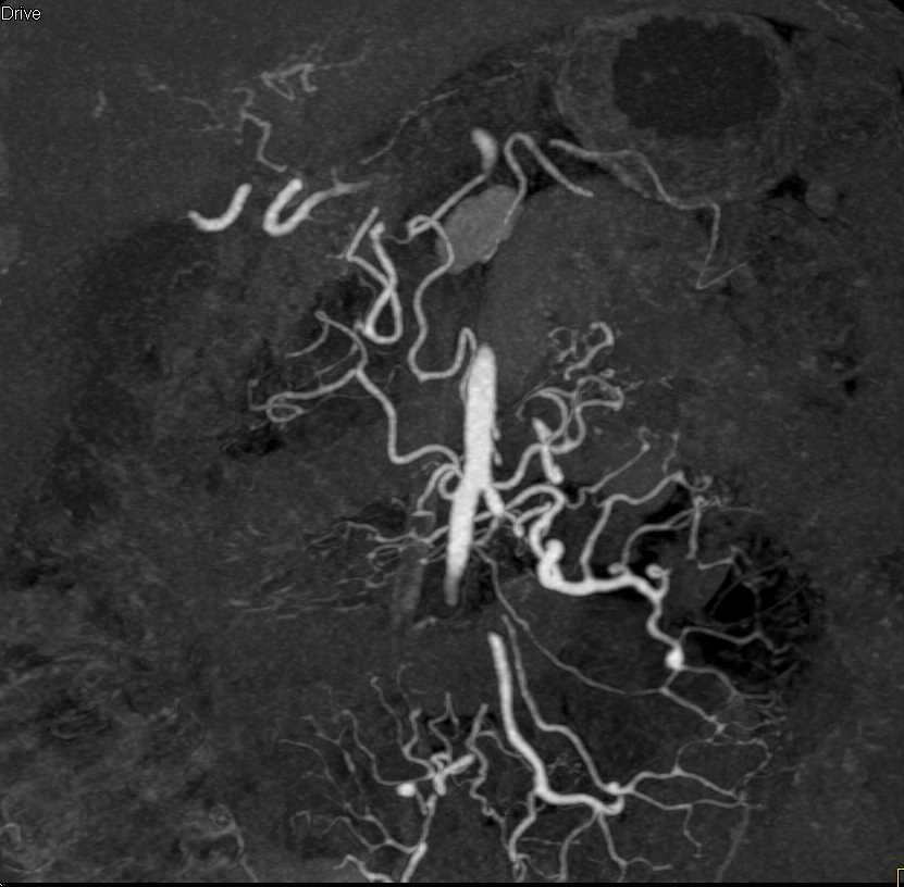Vasculitis Mesentery - CTisus CT Scan