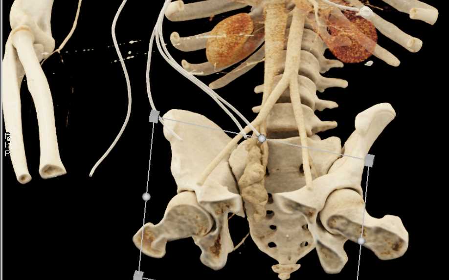 Pelvic AVM - CTisus CT Scan