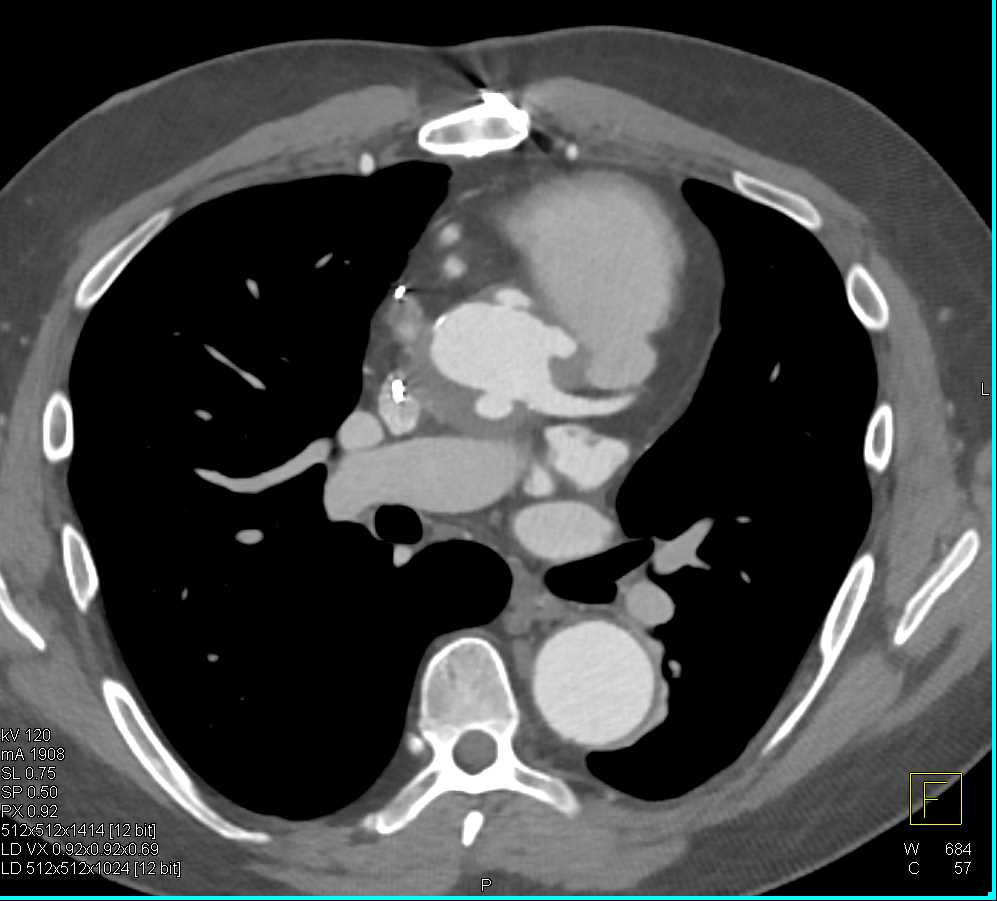 Pseudoaneurysms off the Aortic Root - CTisus CT Scan